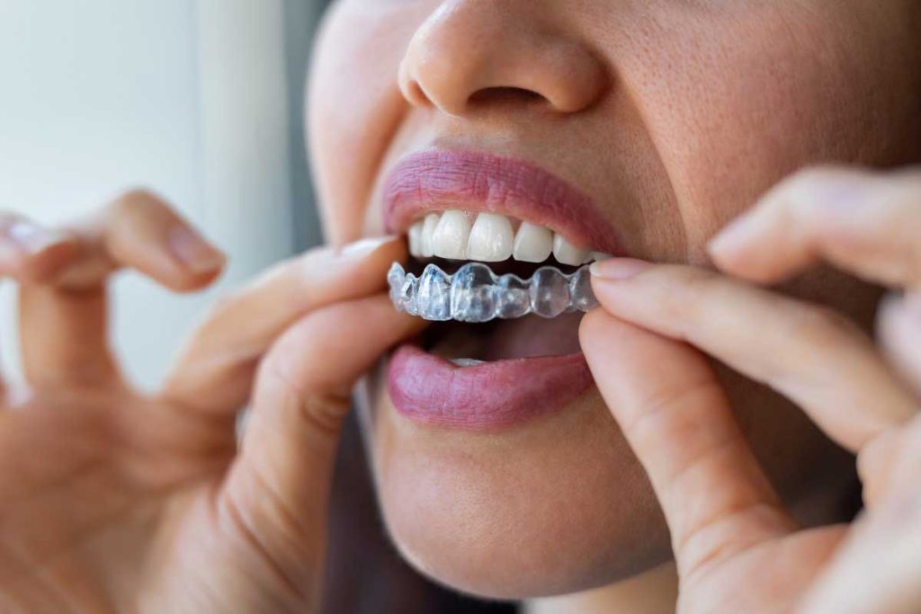 Clear Aligners Streamline Orthodontic Treatment With Comfortable Wear Experience Clear Aligners Streamline Orthodontic Treatment With Comfortable Wear Experience